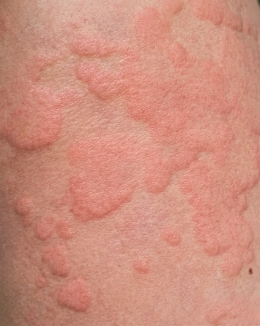 Urticaria at Cinch Clinics